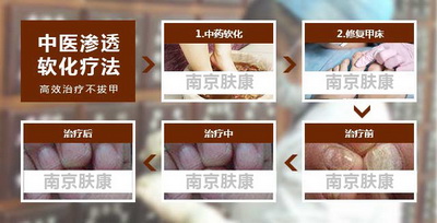 南京治疗灰指甲要多少钱