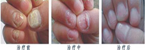 中医渗透软化疗法，让指甲重获新生
