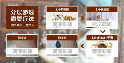 鱼鳞病 分层渗透疗法