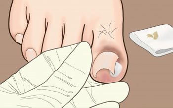 怎么判断有没有得甲沟炎